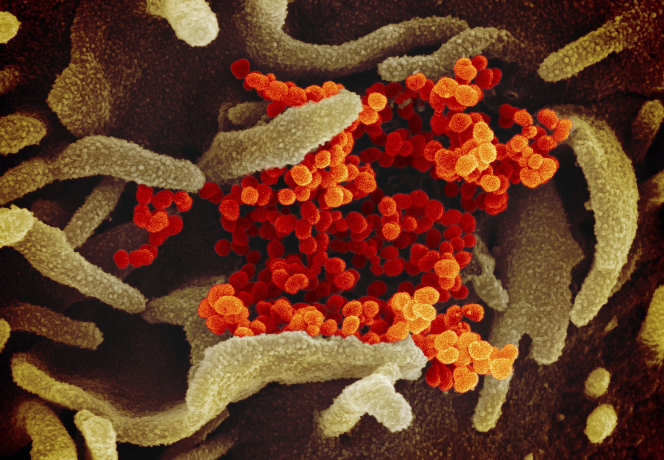 The novel coronavirus SARS-CoV-2, which causes the disease COVID-19.
